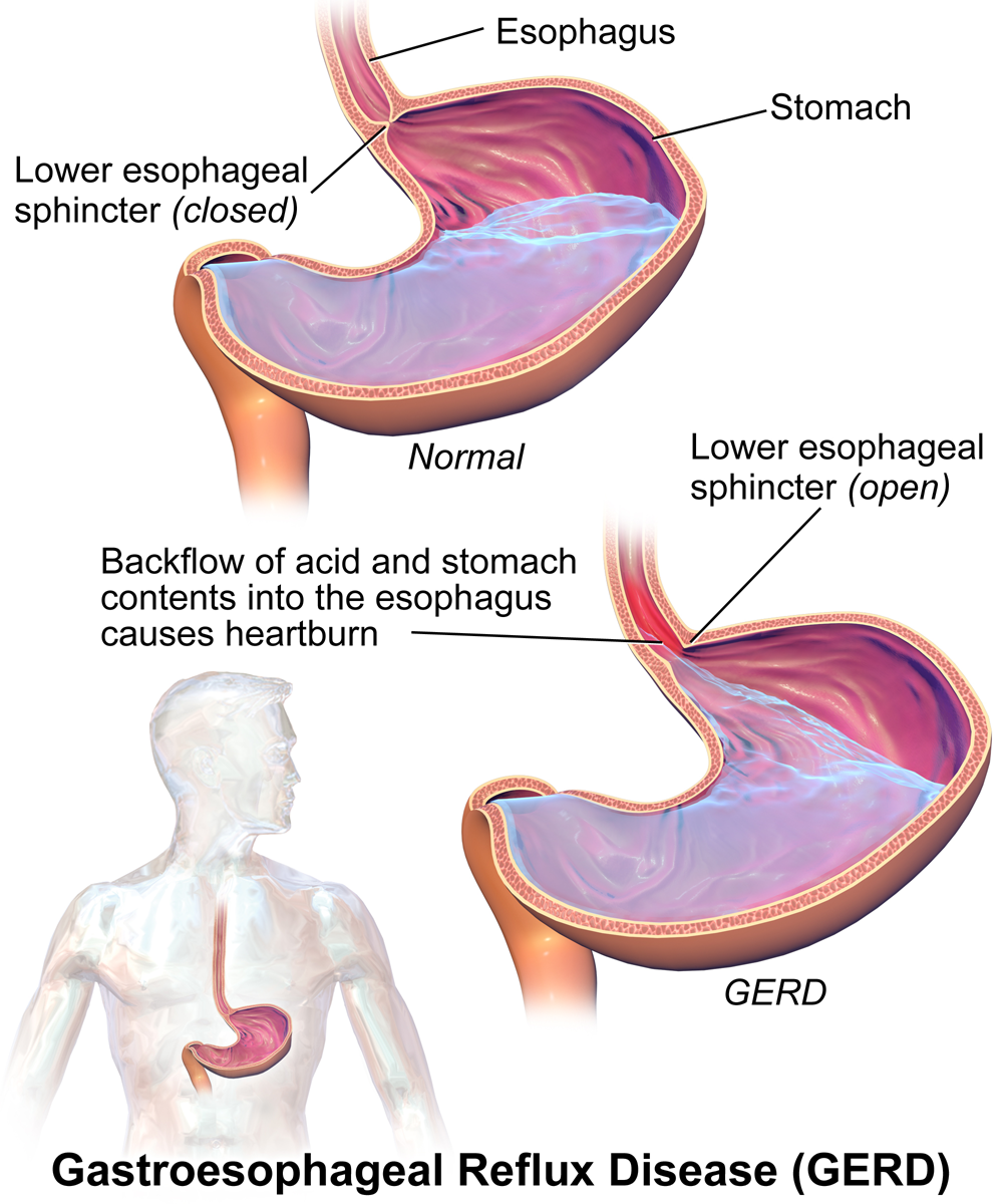 Buy Acid Reflux Medicine Online US Pharmacy Medzino